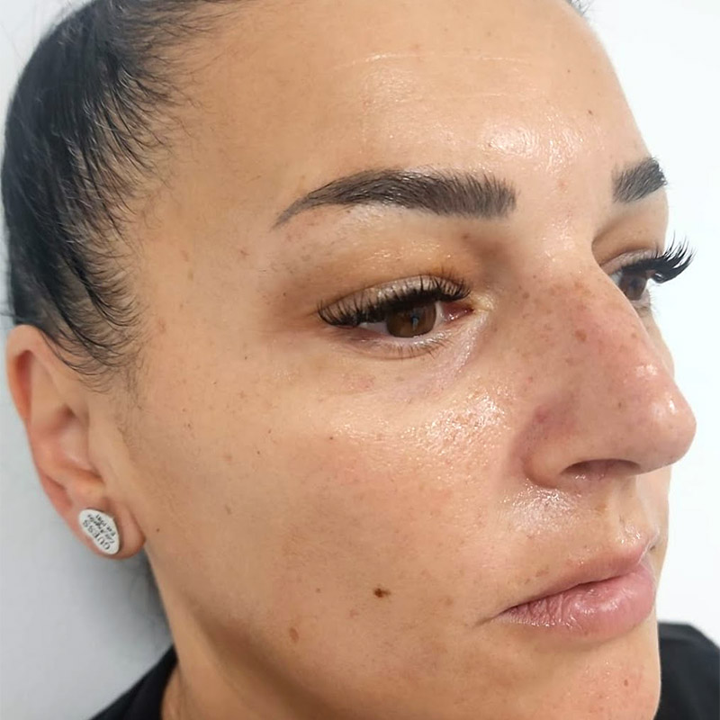 hidratacion facial despues