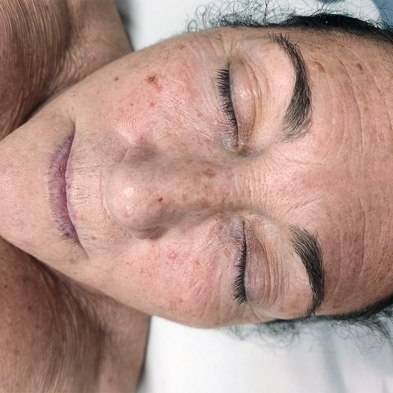 lifting facial antes